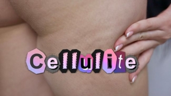 Cellulite! Weibliche Cellulite auf der hohen Nahaufnahme!